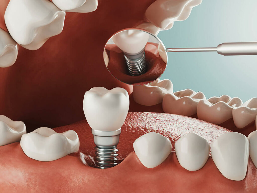 Dental implant illustration