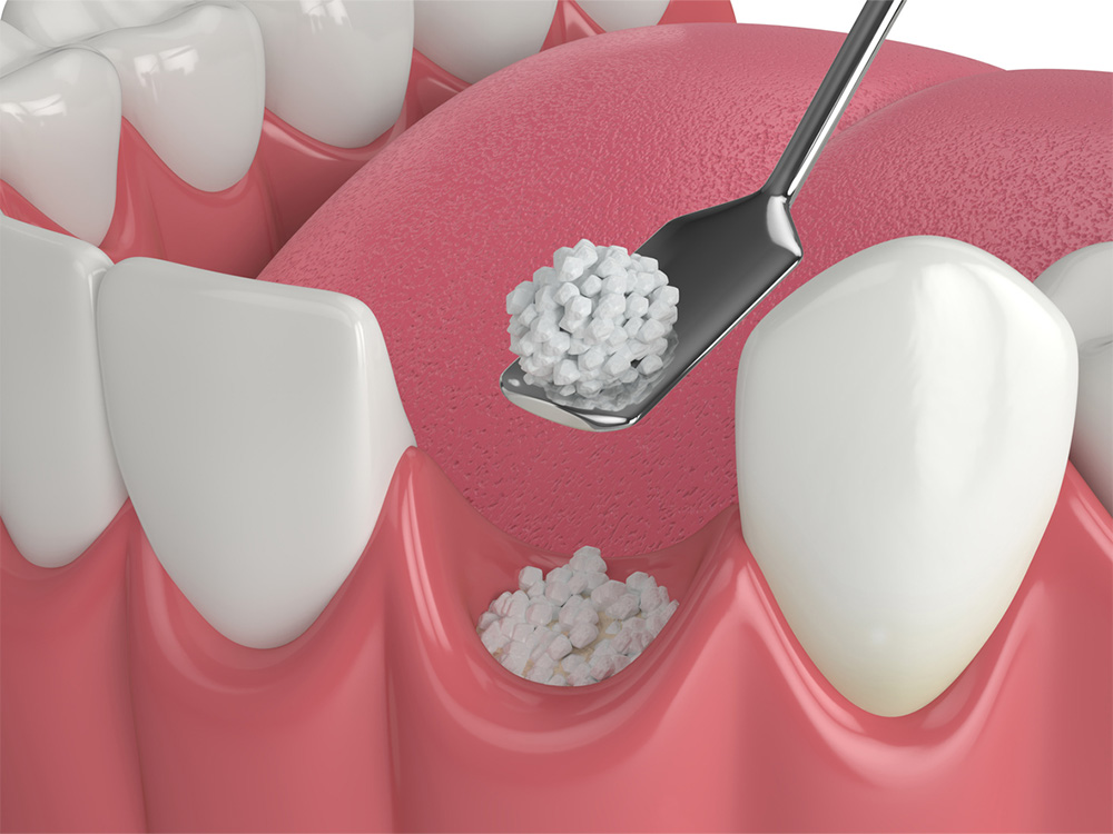 Illustration of dental bone grafting