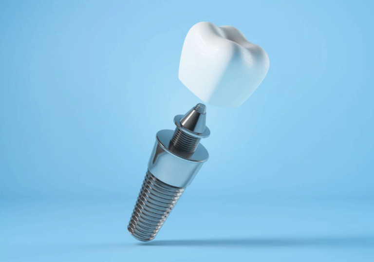 Illustration of a dental implant showing a titanium screw anchored into the jawbone with a ceramic crown above, demonstrating the structure and placement of artificial teeth in restorative dentistry.